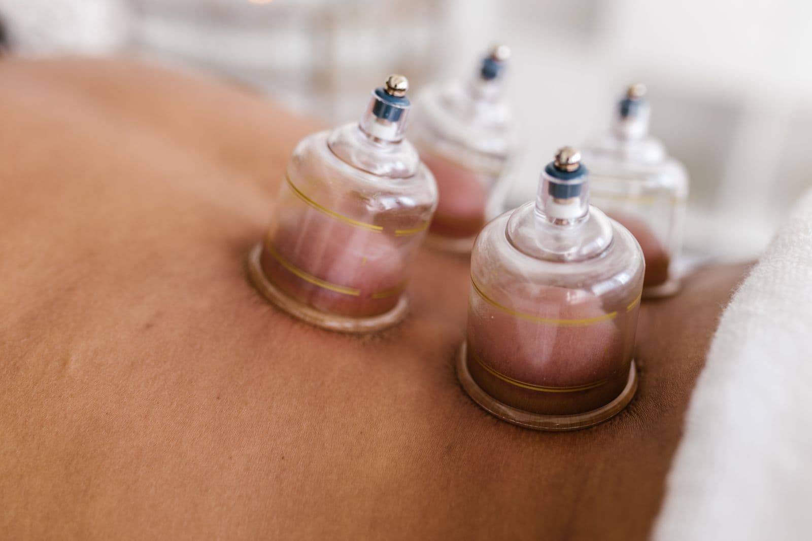 Close-up of glass cupping cups on a person's back